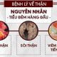 Bệnh tiểu đêm nhiều lần 3 benh-tieu-dem-nhieu-lan
