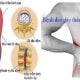 Đau thần kinh tọa 2 trieu-chung-dau-than-kinh-toa
