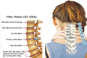Tin tức 1 benh-thoai-hoa-dot-song-co