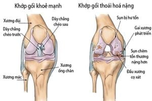 Tin tức 2 benh-thoai-hoa-khop-goi