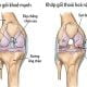 Bệnh thoái hóa khớp gối 3 benh-thoai-hoa-khop-goi