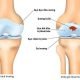 Nguyên tắc vàng phòng bệnh thoái hóa khớp gối 3 nguyen-tac-vang-phong-benh-thoai-hoa-khop-goi
