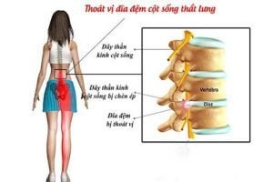 Tin tức 3 benh-thoat-vi-dia-dem-cot-song-that-lung