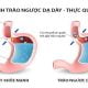 Trào ngược dạ dày 2 trao-nguoc-da-day